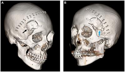 Preservation of the middle meningeal artery during unruptured aneurysm surgery: an independent risk factor for postoperative chronic subdural hematoma